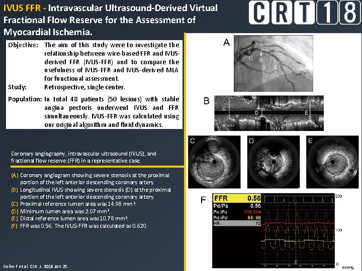 IVUS FFR - Intravascular Ultrasound-Derived Virtual Fractional Flow Reserve for the Assessment of Myocardial