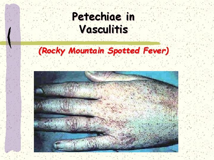Petechiae in Vasculitis (Rocky Mountain Spotted Fever) 