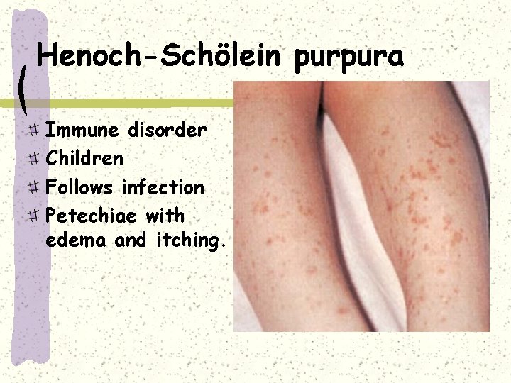 Henoch-Schölein purpura Immune disorder Children Follows infection Petechiae with edema and itching. 