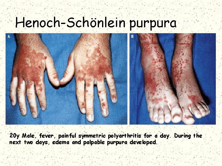 Henoch-Schönlein purpura 20 y Male, fever, painful symmetric polyarthritis for a day. During the
