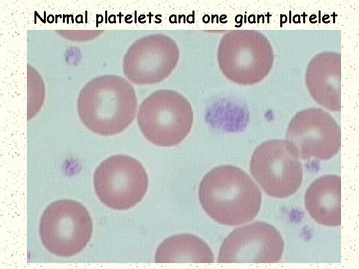 Normal platelets and one giant platelet 