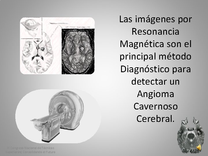 Las imágenes por Resonancia Magnética son el principal método Diagnóstico para detectar un Angioma