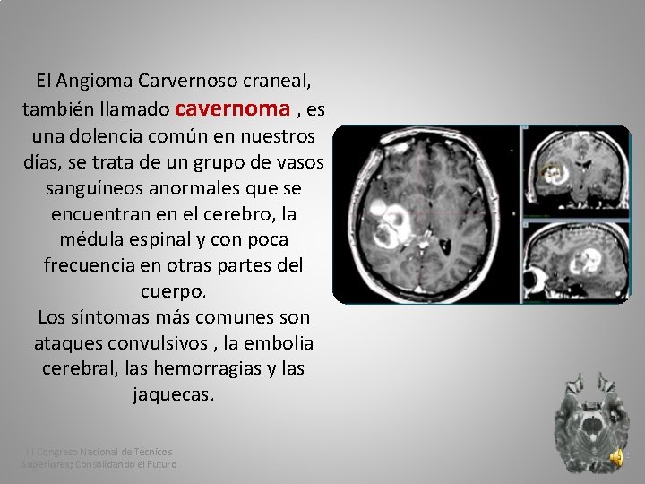 El Angioma Carvernoso craneal, también llamado cavernoma , es una dolencia común en nuestros