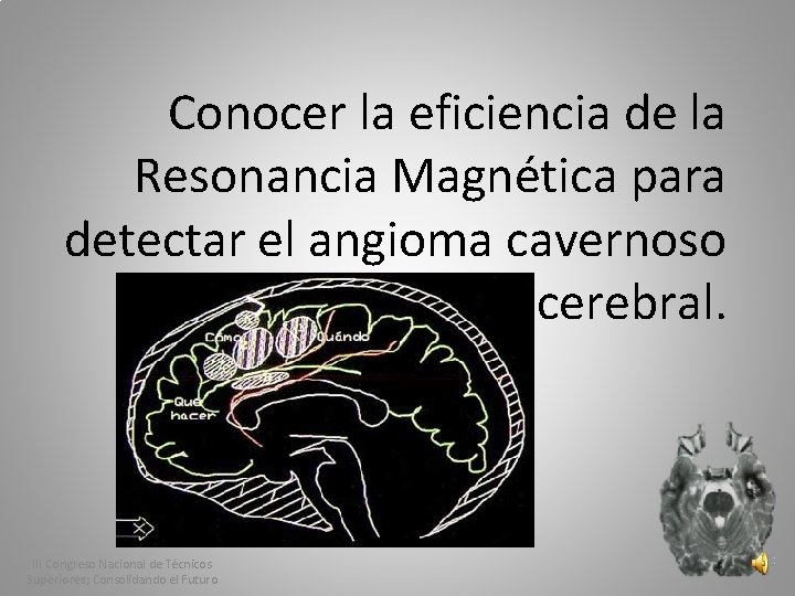 Conocer la eficiencia de la Resonancia Magnética para detectar el angioma cavernoso cerebral. III