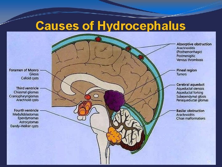 Causes of Hydrocephalus 12 