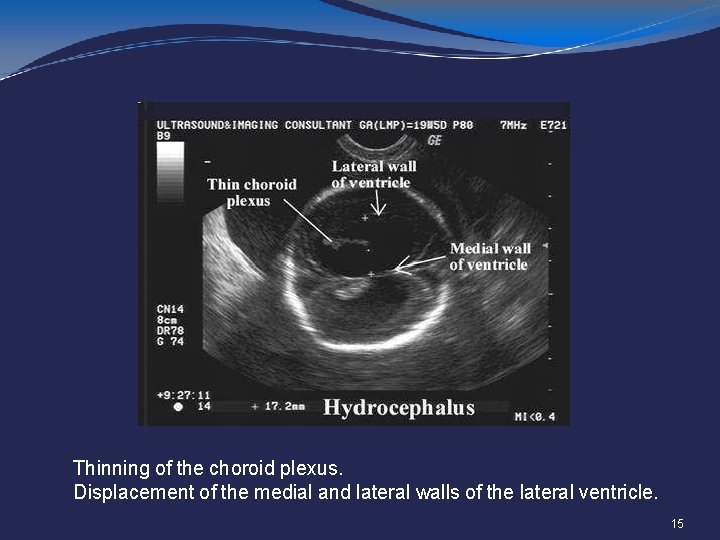 Thinning of the choroid plexus. Displacement of the medial and lateral walls of the