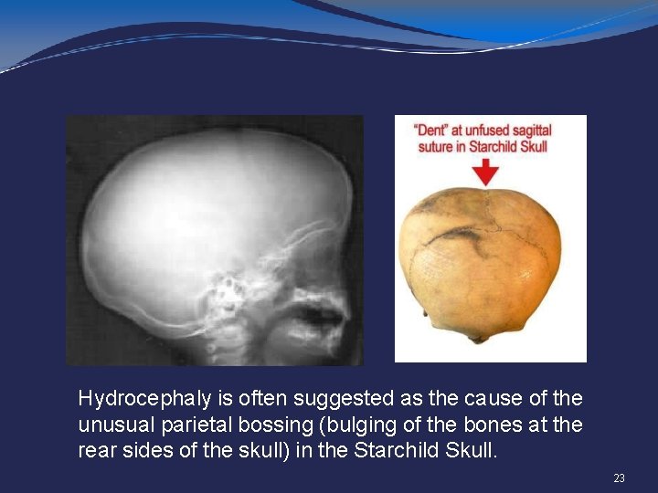 Hydrocephaly is often suggested as the cause of the unusual parietal bossing (bulging of