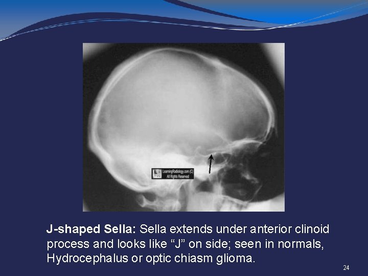 J-shaped Sella: Sella extends under anterior clinoid process and looks like “J” on side;
