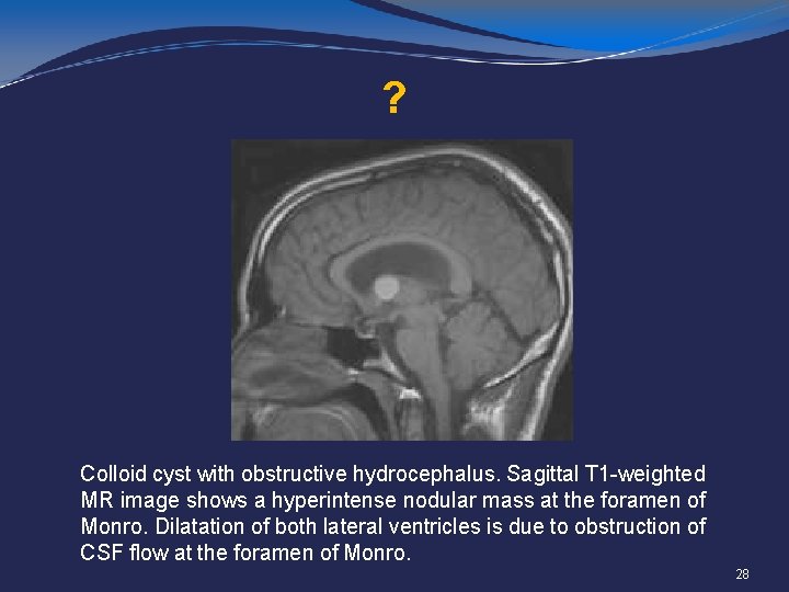 ? Colloid cyst with obstructive hydrocephalus. Sagittal T 1 -weighted MR image shows a