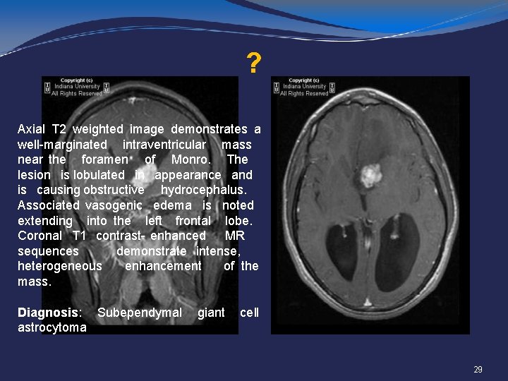 ? Axial T 2 weighted image demonstrates a well-marginated intraventricular mass near the foramen
