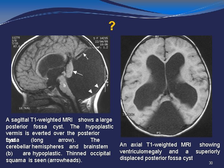 ? A sagittal T 1 -weighted MRI shows a large posterior fossa cyst. The