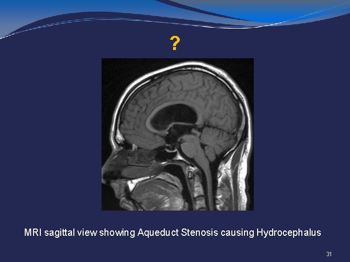 ? MRI sagittal view showing Aqueduct Stenosis causing Hydrocephalus 31 