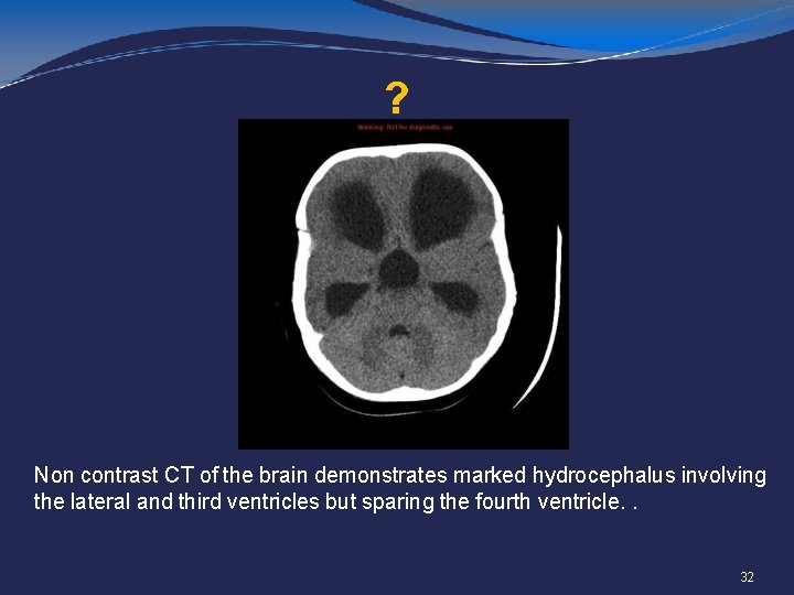 ? Non contrast CT of the brain demonstrates marked hydrocephalus involving the lateral and