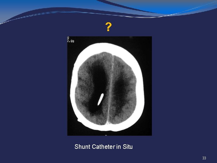 ? Shunt Catheter in Situ 33 