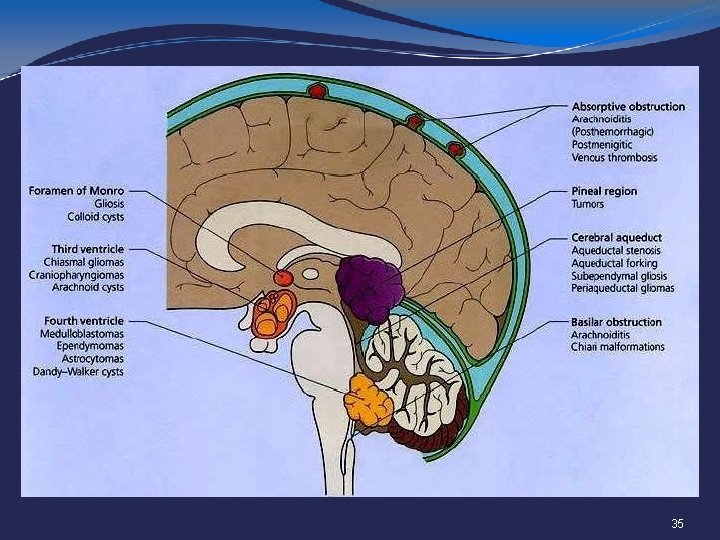 ? Medulloblastoma: sagittal view MRI showing an avidly enhancing solid and cystic lesion filling