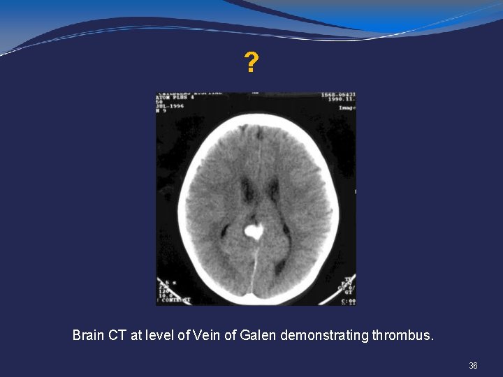 ? Brain CT at level of Vein of Galen demonstrating thrombus. 36 