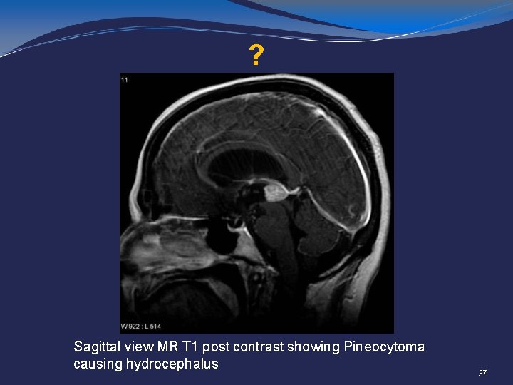 ? Sagittal view MR T 1 post contrast showing Pineocytoma causing hydrocephalus 37 