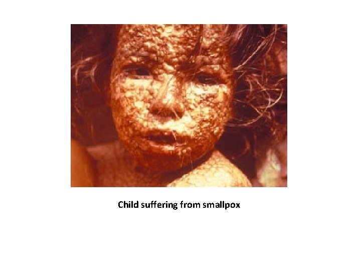 Child suffering from smallpox 
