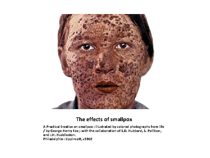 The effects of smallpox A Practical treatise on smallpox : illustrated by colored photographs