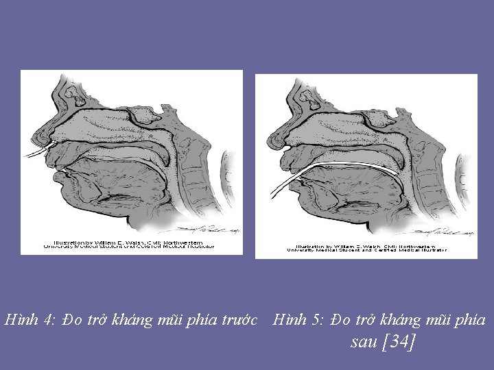 Hình 4: Đo trở kháng mũi phía trước Hình 5: Đo trở kháng mũi Hình 4: Đo trở kháng mũi phía trước Hình 5: Đo trở kháng mũi