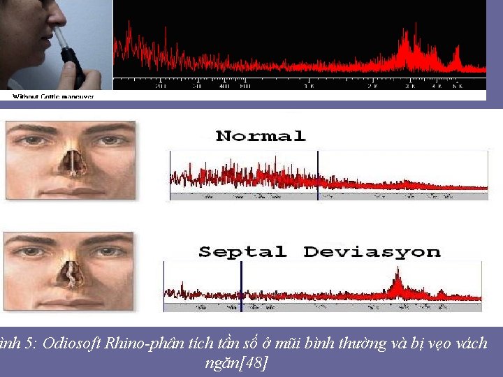 ình 5: Odiosoft Rhino-phân tích tần số ở mũi bình thường và bị vẹo ình 5: Odiosoft Rhino-phân tích tần số ở mũi bình thường và bị vẹo