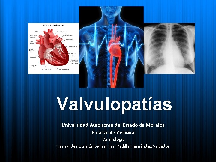 Valvulopatías Universidad Autónoma del Estado de Morelos Facultad de Medicina Cardiología Hernández Gurrión Samantha.