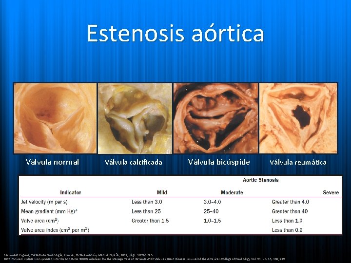 Estenosis aórtica Válvula normal Válvula calcificada Válvula bicúspide Válvula reumática • > 60 años