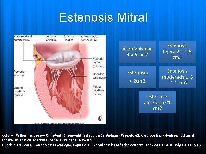 Estenosis Mitral Área Valvular 4 a 6 cm 2 Estenosis < 2 cm 2