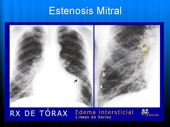 Estenosis Mitral 