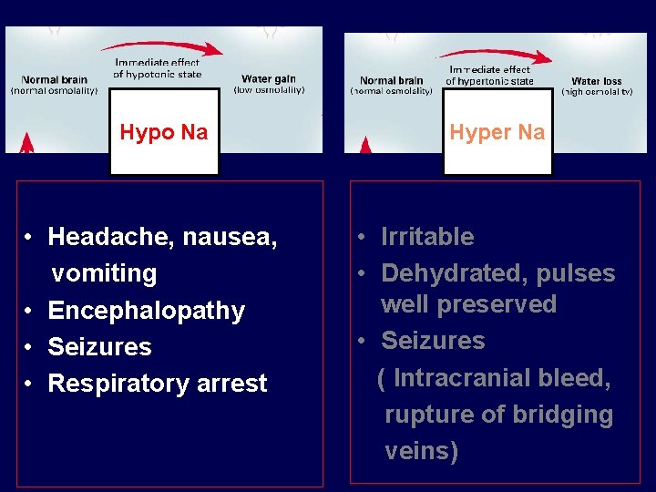 Hypo Na • Headache, nausea, vomiting • Encephalopathy • Seizures • Respiratory arrest Hyper