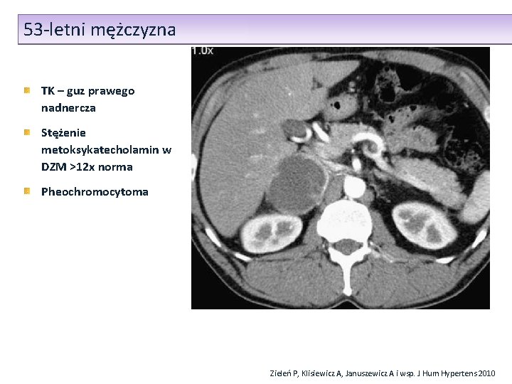 53 -letni mężczyzna TK – guz prawego nadnercza Stężenie metoksykatecholamin w DZM >12 x