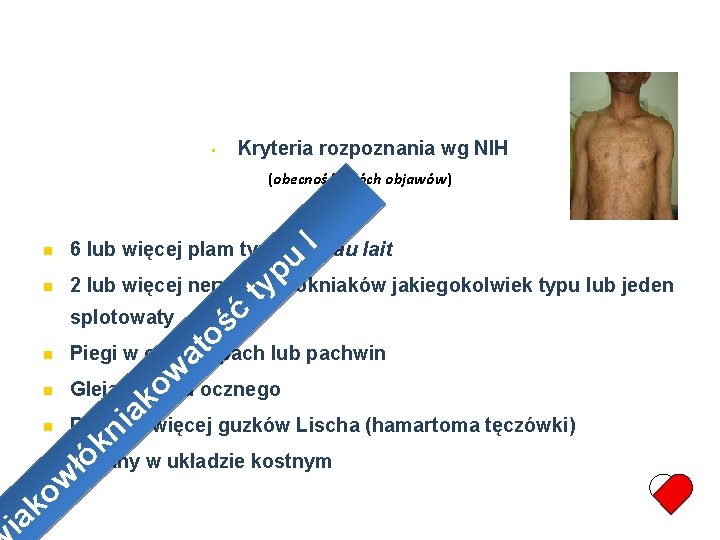 • Kryteria rozpoznania wg NIH (obecność dwóch objawów) I 6 lub więcej plam • Kryteria rozpoznania wg NIH (obecność dwóch objawów) I 6 lub więcej plam