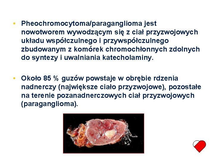  • Pheochromocytoma/paraganglioma jest nowotworem wywodzącym się z ciał przyzwojowych układu współczulnego i przywspółczulnego