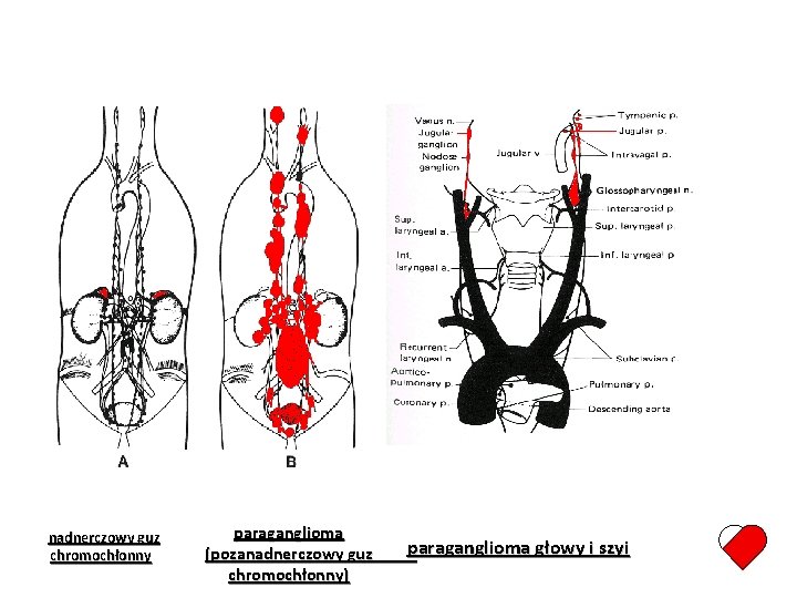 nadnerczowy guz chromochłonny paraganglioma (pozanadnerczowy guz chromochłonny) paraganglioma głowy i szyi 