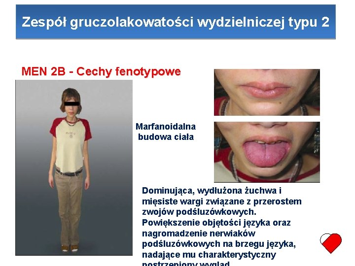 Zespół gruczolakowatości wydzielniczej typu 2 MEN 2 B - Cechy fenotypowe Marfanoidalna budowa ciała