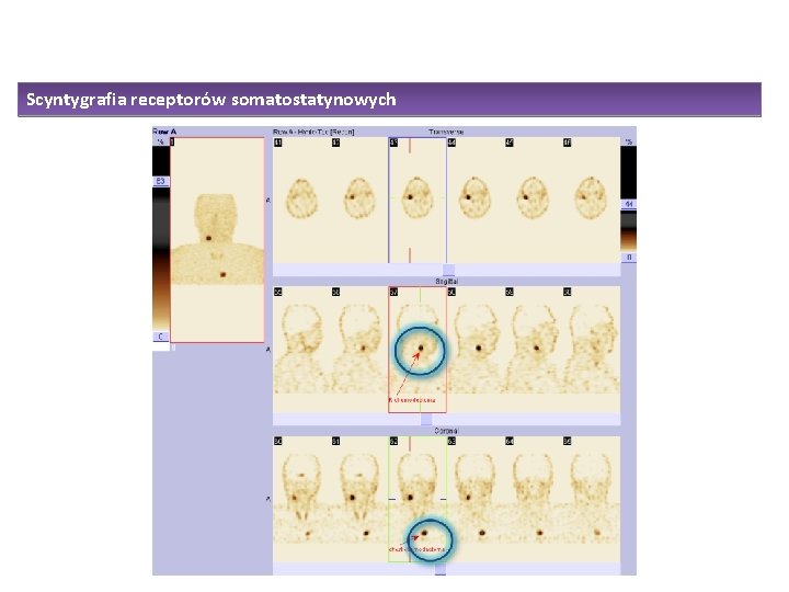 Scyntygrafia receptorów somatostatynowych 