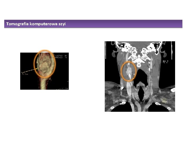 Tomografia komputerowa szyi 