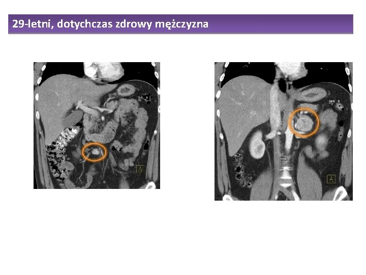 29 -letni, dotychczas zdrowy mężczyzna 