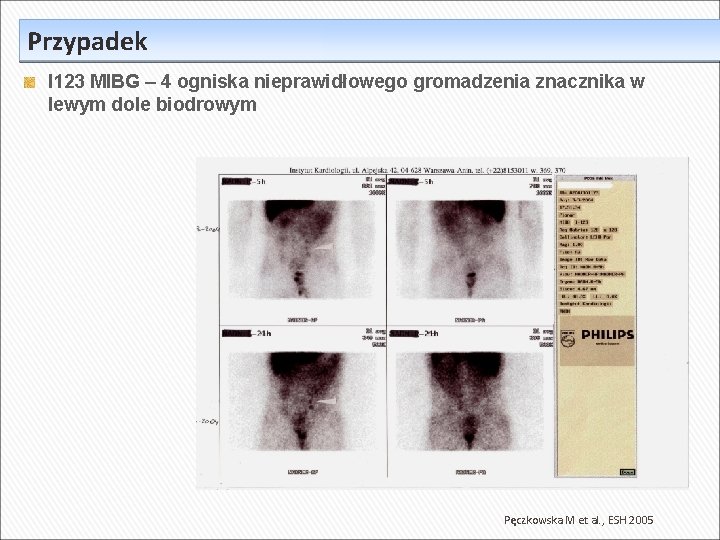 Przypadek I 123 MIBG – 4 ogniska nieprawidłowego gromadzenia znacznika w lewym dole biodrowym