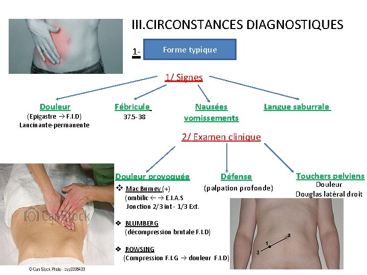 III. CIRCONSTANCES DIAGNOSTIQUES 1 - Forme typique 1/ Signes Douleur (Epigastre F. I. D)