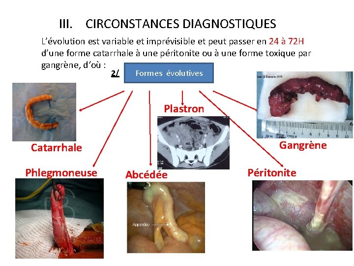 III. CIRCONSTANCES DIAGNOSTIQUES L’évolution est variable et imprévisible et peut passer en 24 à