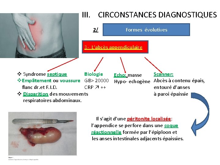 III. CIRCONSTANCES DIAGNOSTIQUES 2/ Formes évolutives 3 - L’abcès appendiculaire v Syndrome septique Biologie