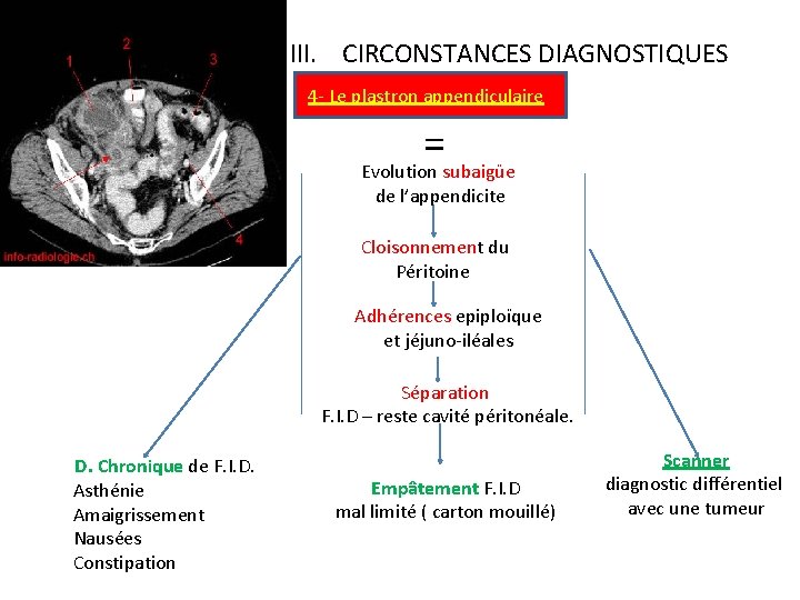 III. CIRCONSTANCES DIAGNOSTIQUES 4 - Le plastron appendiculaire = Evolution subaigüe de l’appendicite Cloisonnement