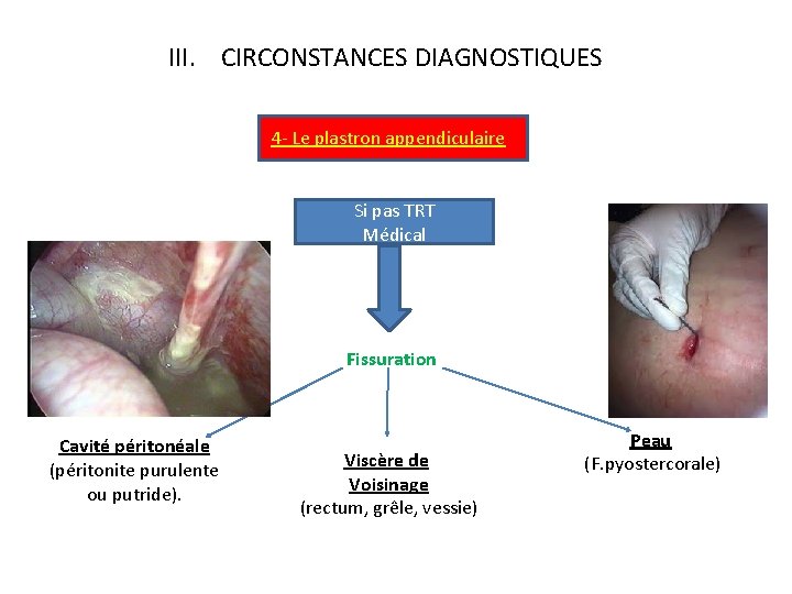 III. CIRCONSTANCES DIAGNOSTIQUES 4 - Le plastron appendiculaire Si pas TRT Médical Fissuration Cavité