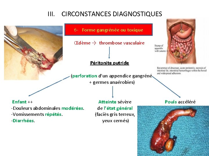 III. CIRCONSTANCES DIAGNOSTIQUES 6 - Forme gangrénée ou toxique Œdème → thrombose vasculaire Péritonite