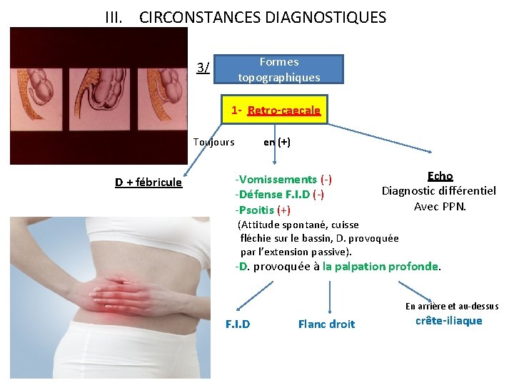 III. CIRCONSTANCES DIAGNOSTIQUES Formes topographiques 3/ 1 - Retro-caecale Toujours D + fébricule en