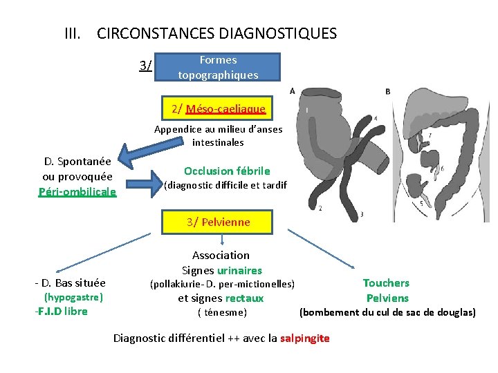 III. CIRCONSTANCES DIAGNOSTIQUES 3/ Formes topographiques 2/ Méso-caeliaque Appendice au milieu d’anses intestinales D.