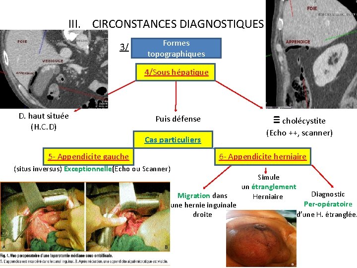 III. CIRCONSTANCES DIAGNOSTIQUES 3/ Formes topographiques 4/Sous hépatique D. haut située (H. C. D)