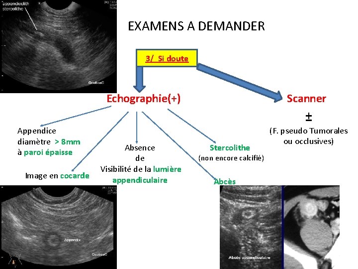 IV. EXAMENS A DEMANDER 3/ Si doute Echographie(+) Appendice diamètre > 8 mm à