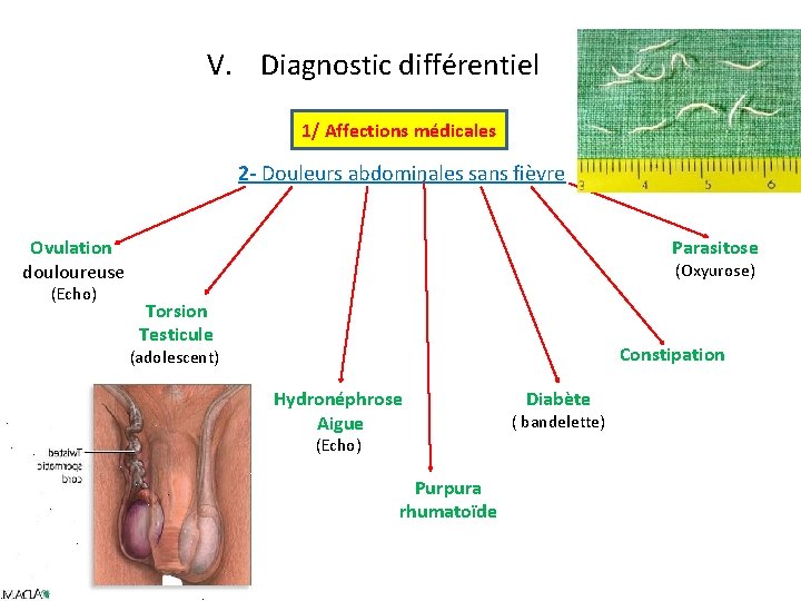 V. Diagnostic différentiel 1/ Affections médicales 2 - Douleurs abdominales sans fièvre Ovulation douloureuse